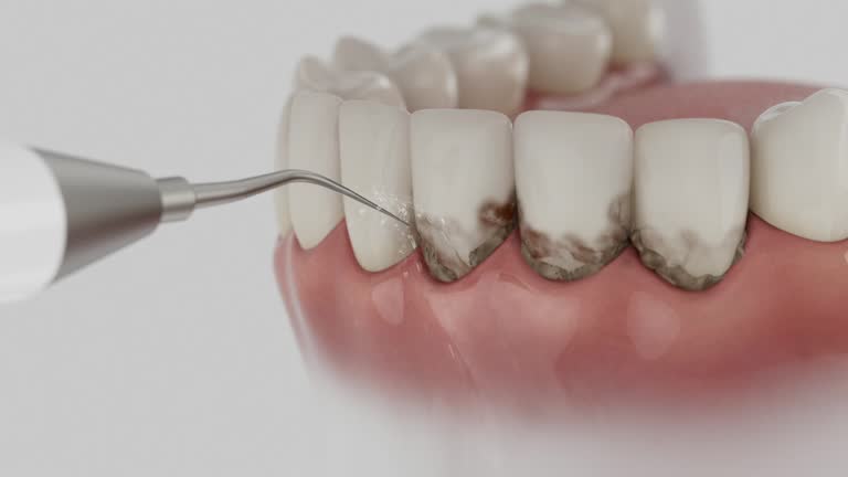 Trusted Wisdom Tooth Removal service in Stony Prairie, OH - Dentist Open Now